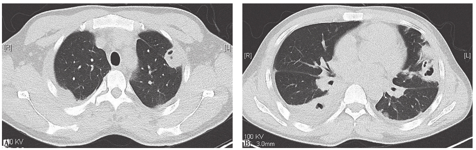 图2 金黄色葡萄球菌性肺脓肿胸部CT表现-57a880259bc24e50a1e4d5b24ddc8984.jpg